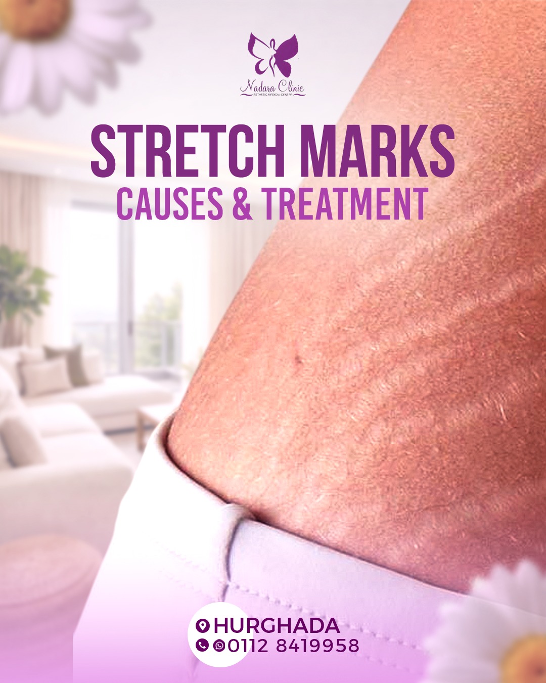 Causes of stretch marks and treatment methods in Hurghada